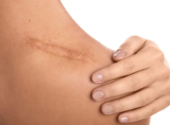 scar tissue - Perfect Balance Medical Center scar tissue