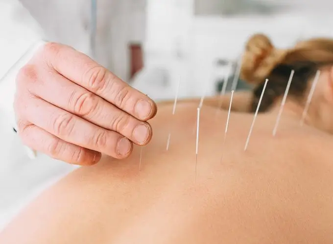 Acupuncture - Perfect Balance Rehabilitation Centre Acupuncture