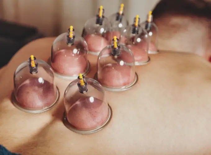 Cupping - Perfect Balance Rehabilitation Centre Cupping